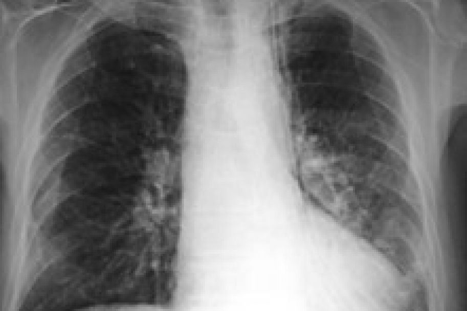 Pomiary temperatury oddechu mogą pomóc w diagnostyce raka płuca