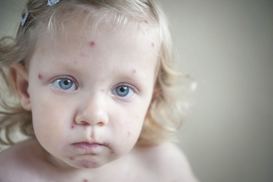Przybywa dzieci niezaszczepionych przeciwko odrze