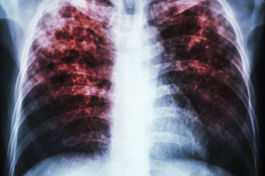 Choroba płuc gorsza niż wiele nowotworów