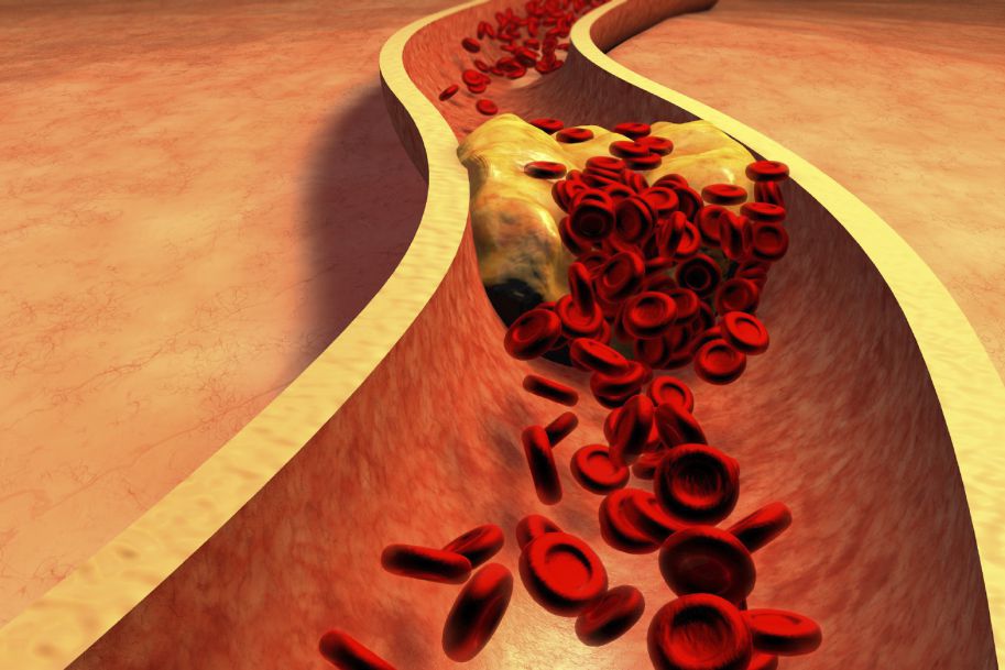 Podwyższony poziom cholesterolu nie jest mitem, a statyny ratują życie