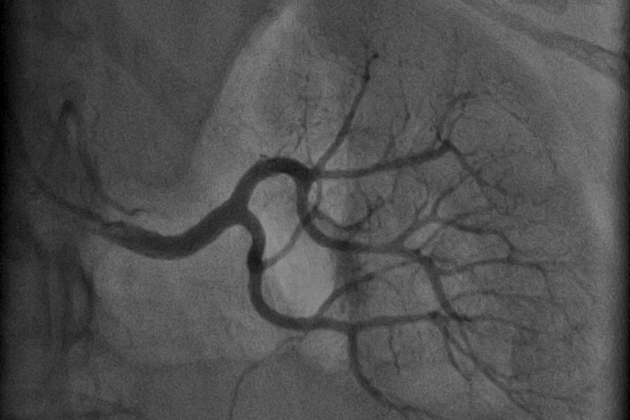 Angioplastyka tętnic nerkowych – współczesne zasady postępowania