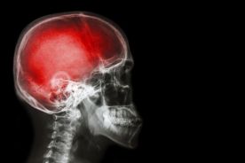 Urazy głowy – postępowanie w praktyce neurologicznej