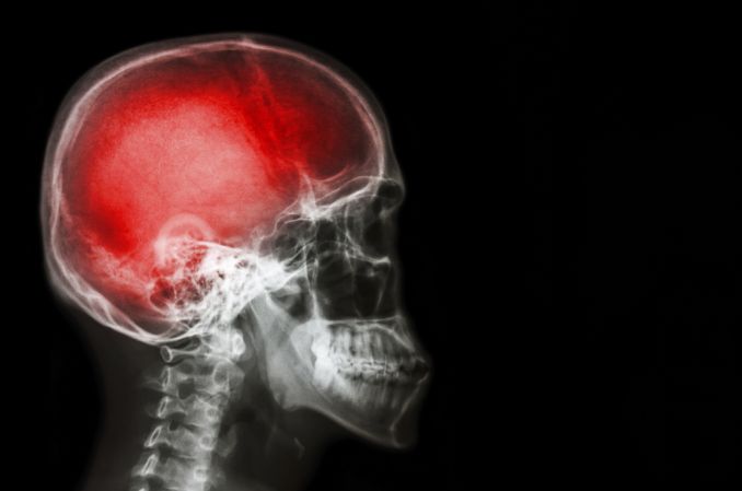 Urazy głowy – postępowanie w praktyce neurologicznej