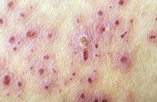 Antybiotykoterapia mieszanych zakażeń skóry