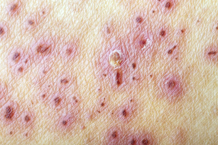 Antybiotykoterapia mieszanych zakażeń skóry