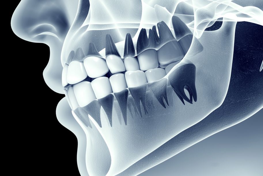 Laryngologiczne powikłania zębopochodne
