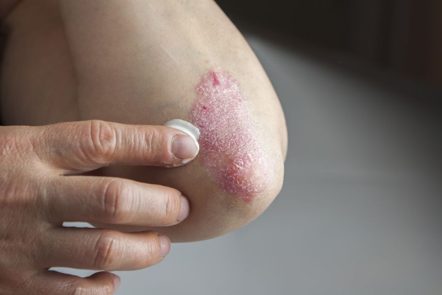 Nowe badana kliniczne leczenia egzemy skóry