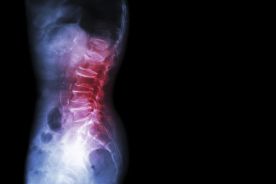 Terapia glikokortykoidami a zagrożenie osteoporozą