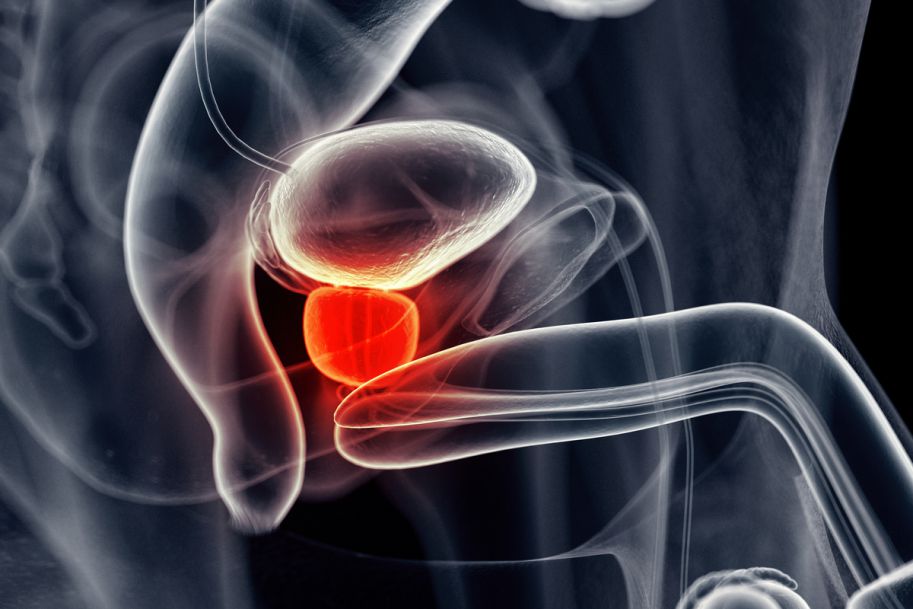 Rak prostaty to najczęstszy nowotwór u mężczyzn