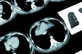 Diagnostyka pojedynczego guzka płuca – aktualne zalecenia