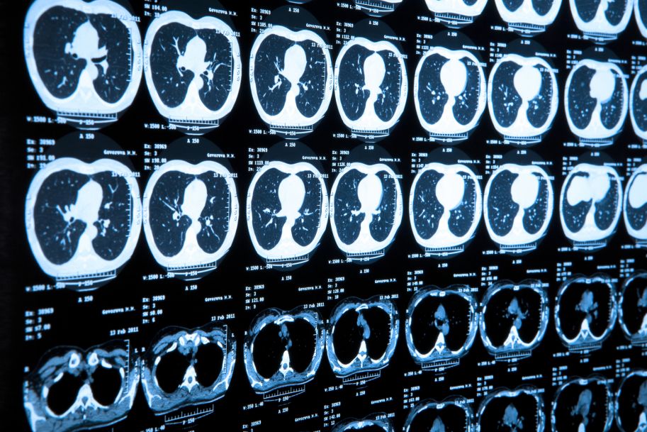 Diagnostyka obrazowa raka płuca