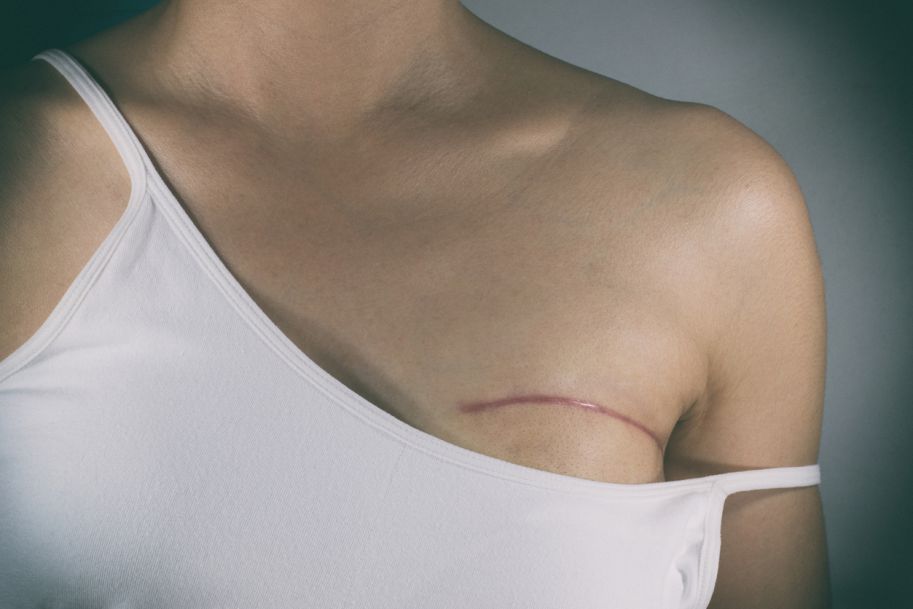 Niebezpieczne implanty piersi?