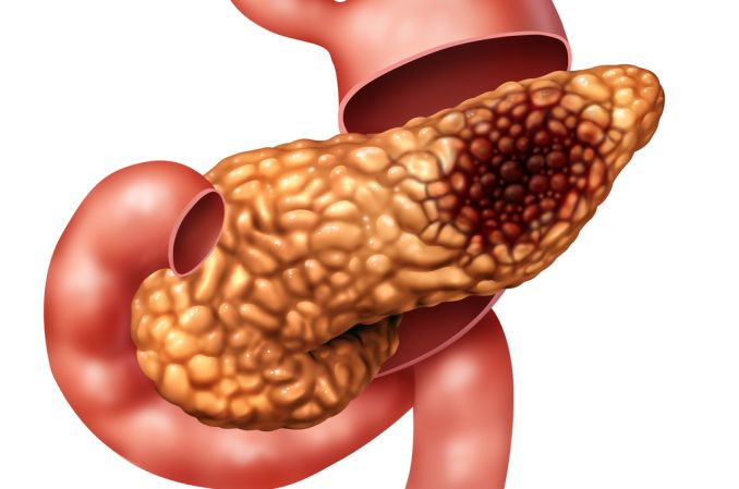 Efektywność szczepionki mRNA przeciwko rakowi trzustki