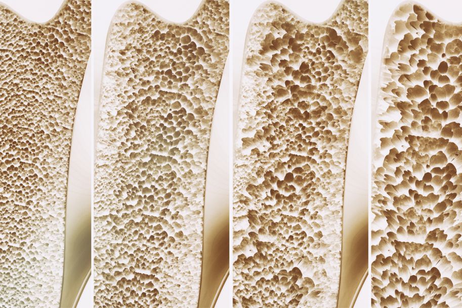 Otyłość a osteoporoza – powiązania między tkanką tłuszczową i kostną