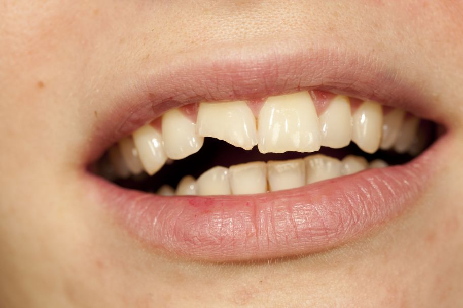 Ekstruzja ortodontyczna jako metoda leczenia złamań koronowo-korzeniowych zębów stałych – aktualny stan wiedzy