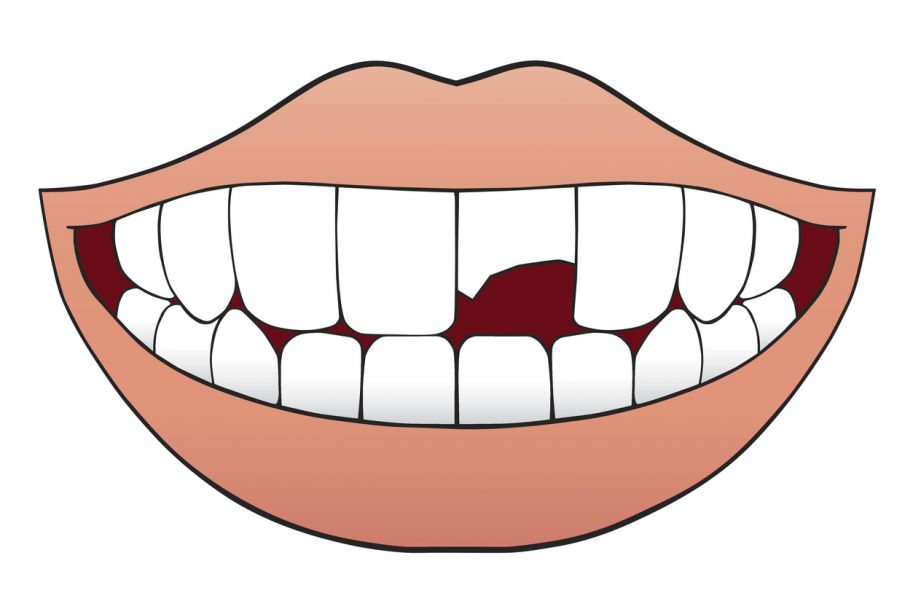 Kliniczna klasyfikacja urazowych uszkodzeń zębów według Andreasena