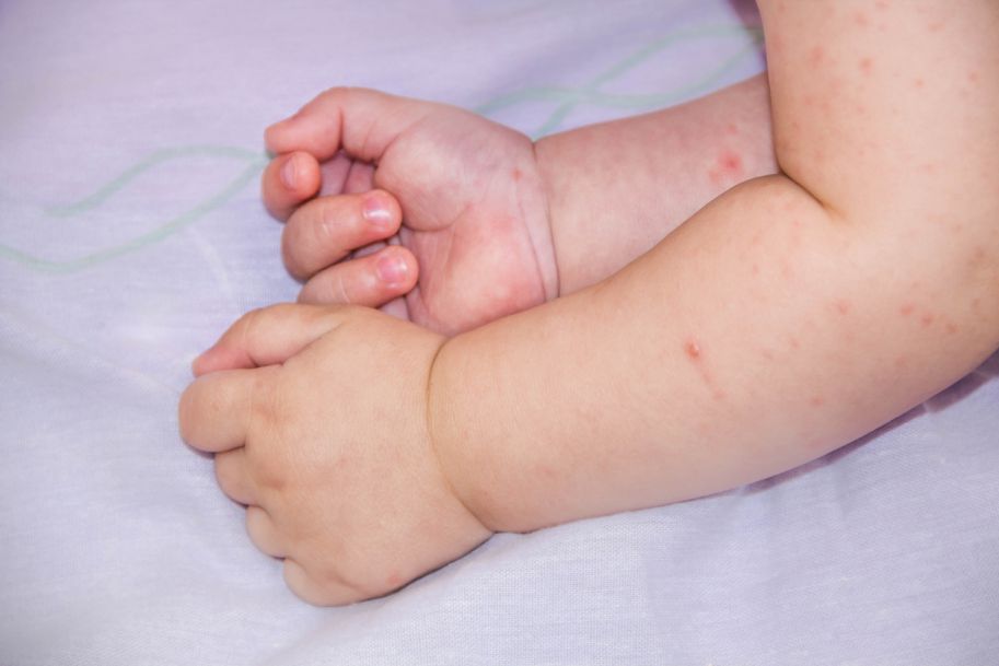 Reakcje alergiczne na antybiotyki u dzieci