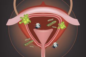 Nawracające zakażenia układu moczowego u kobiet: patogeneza, leczenie i zapobieganie