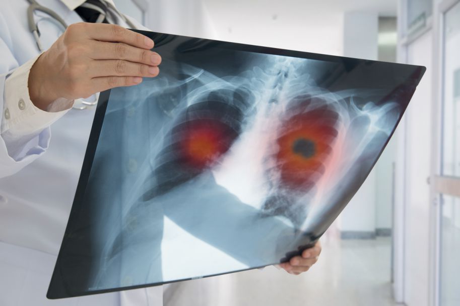 Zdjęcie rentgenowskie pozwala przewidzieć zgon