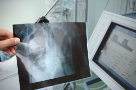Najnowsze rekomendacje GOLD 2018 w diagnostyce i leczeniu pacjentów z przewlekłą obturacyjną chorobą płuc (POChP)
