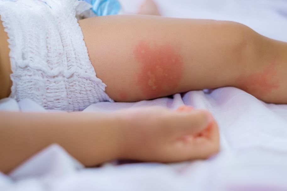 Diagnostyka alergii na penicyliny i cefalosporyny – wskazówki praktyczne