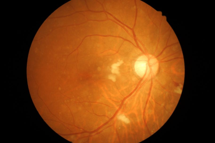 Podstawowe zasady postępowania z pacjentem z retinopatią cukrzycową dla lekarzy rodzinnych i diabetologów