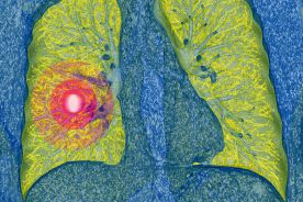 Nowe metody leczenia niedrobnokomórkowego raka płuca
