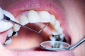 Przylistki chmielu dla zdrowia zębów