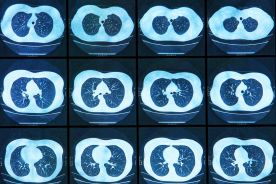 Aktualne metody diagnostyki raka płuca – podstawy terapii personalizowanej