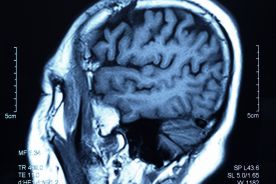 Bielski szpital wprowadził nowoczesne metody leczenia wad naczyniowych mózgu