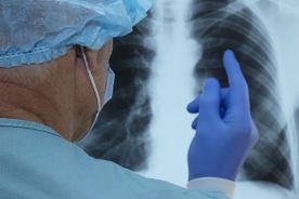Zmniejszenie przerzutów u chorych na raka płuca