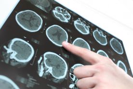 Rezonans magnetyczny i uczenie maszynowe może wspomóc wykrywanie chorób psychicznych
